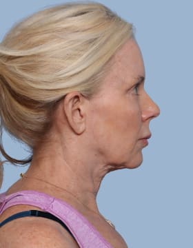 Deep Plane Facelift before - side right