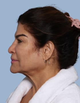 Deep Plane Facelift before - side left
