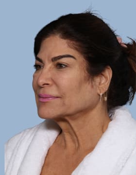 Deep Plane Facelift before - oblique left