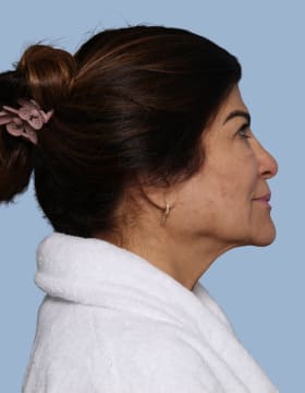 Deep Plane Facelift before - side right