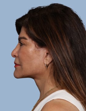 Deep Plane Facelift after - side left