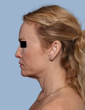 Deep Plane Facelift before - side left