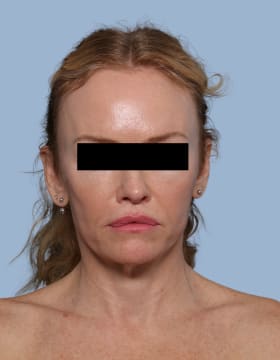 Deep Plane Facelift before - front view
