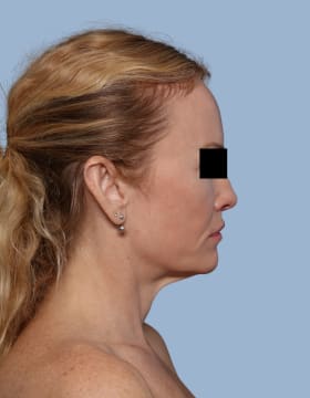 Deep Plane Facelift before - side right