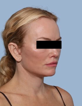 Deep Plane Facelift after - oblique right