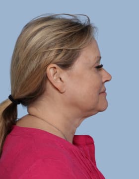 Deep Plane Facelift before - side right
