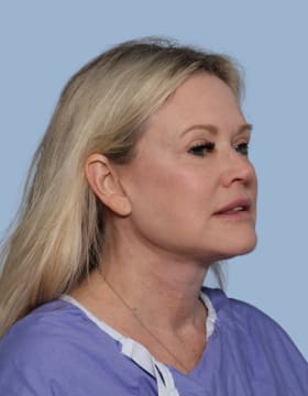 Deep Plane Facelift after - oblique right
