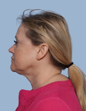 Deep Plane Facelift before - side left