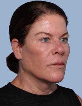 Deep Plane Facelift after - oblique right