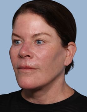 Deep Plane Facelift after - oblique left