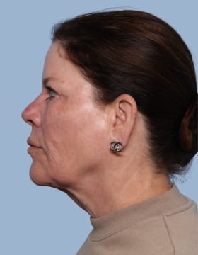 Deep Plane Facelift before - side left