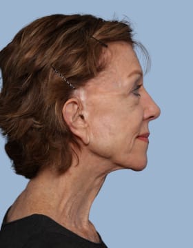Deep Plane Facelift before - side right