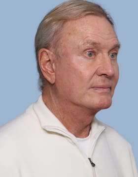 Deep Plane Facelift after - oblique right