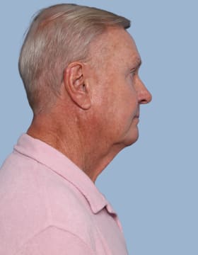 Deep Plane Facelift before - side right