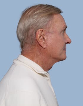 Deep Plane Facelift after - side right