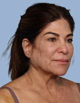 Deep Plane Facelift before - oblique right