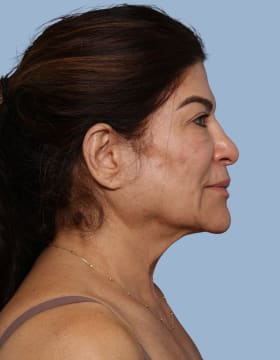 Deep Plane Facelift before - side right