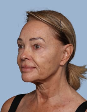 Deep Plane Facelift before - oblique left