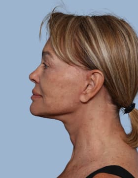 Deep Plane Facelift after - side left