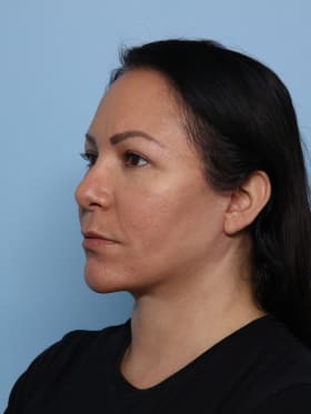 Facelift after - oblique left