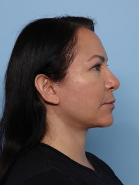 Facelift after - side right