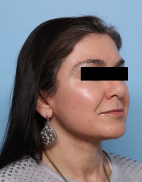 Facelift after - oblique right