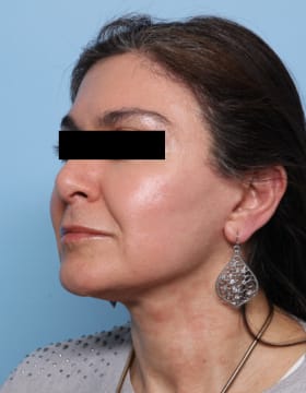 Facelift after - oblique left