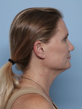 Facelift before - side right