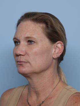 Facelift before - oblique left