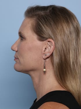 Facelift after - side left