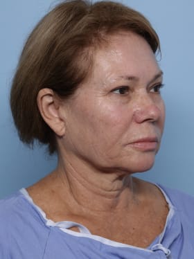 Facelift before - oblique right