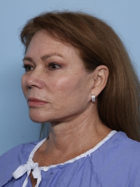 Facelift after - oblique left