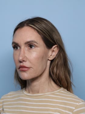 Facelift before - oblique left