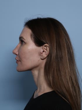 Facelift after - side left