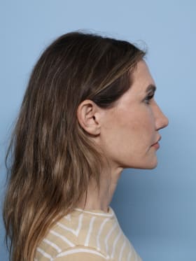 Facelift before - side right