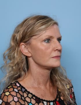 Facelift after - oblique right