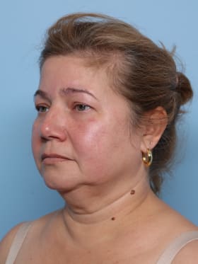 Facelift before - oblique left