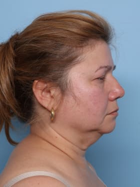Facelift before - side right