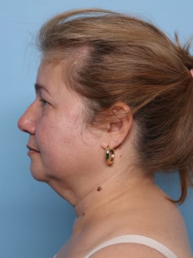 Facelift before - side left