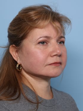 Facelift after - oblique right