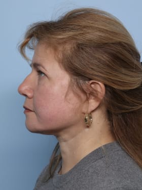 Facelift after - side left