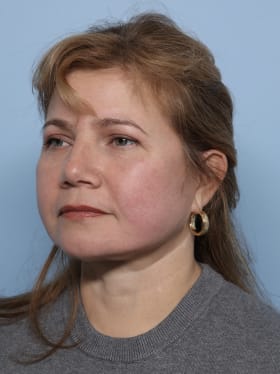 Facelift after - oblique left