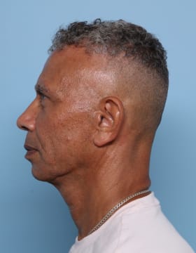 Facelift before - side left