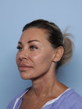 Facelift after - oblique left