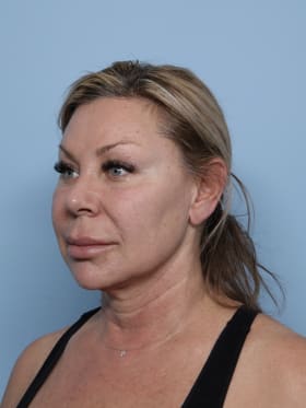 Facelift before - oblique left