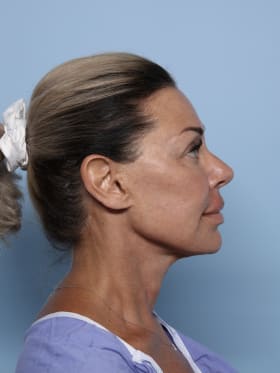 Facelift after - side right
