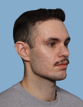 Jaw Implants after - oblique right