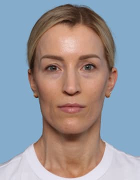 Blepharoplasty before - front view