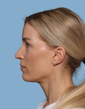 Blepharoplasty before - side left
