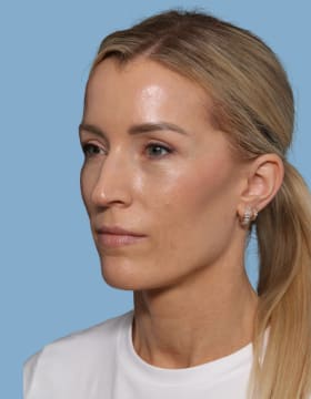 Blepharoplasty after - oblique left